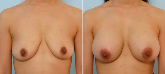 Breast Augmentation before and after photos in Houston, TX, Patient 25516