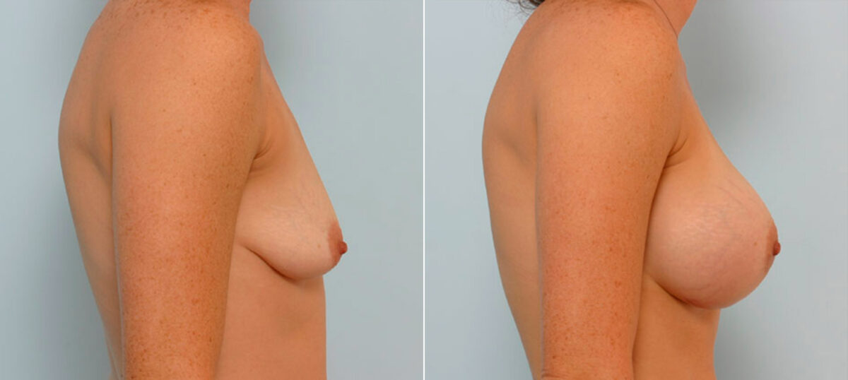Breast Augmentation before and after photos in Houston, TX, Patient 25523