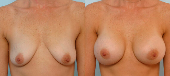 Breast Augmentation before and after photos in Houston, TX, Patient 25523