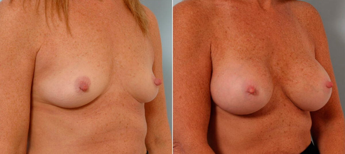 Breast Augmentation before and after photos in Houston, TX, Patient 25530