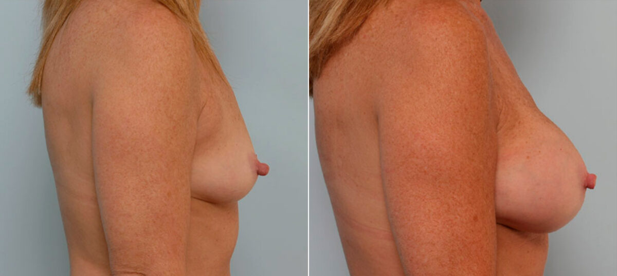 Breast Augmentation before and after photos in Houston, TX, Patient 25530