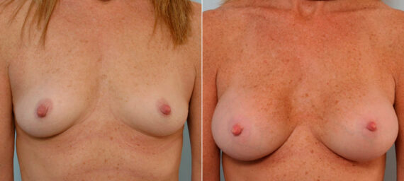 Breast Augmentation before and after photos in Houston, TX, Patient 25530