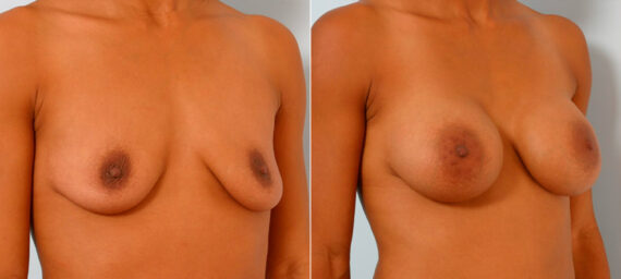 Breast Augmentation before and after photos in Houston, TX, Patient 25537