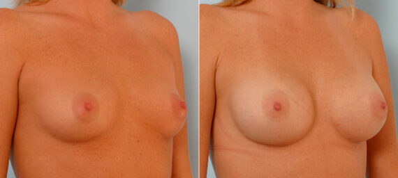 Breast Augmentation before and after photos in Houston, TX, Patient 25544