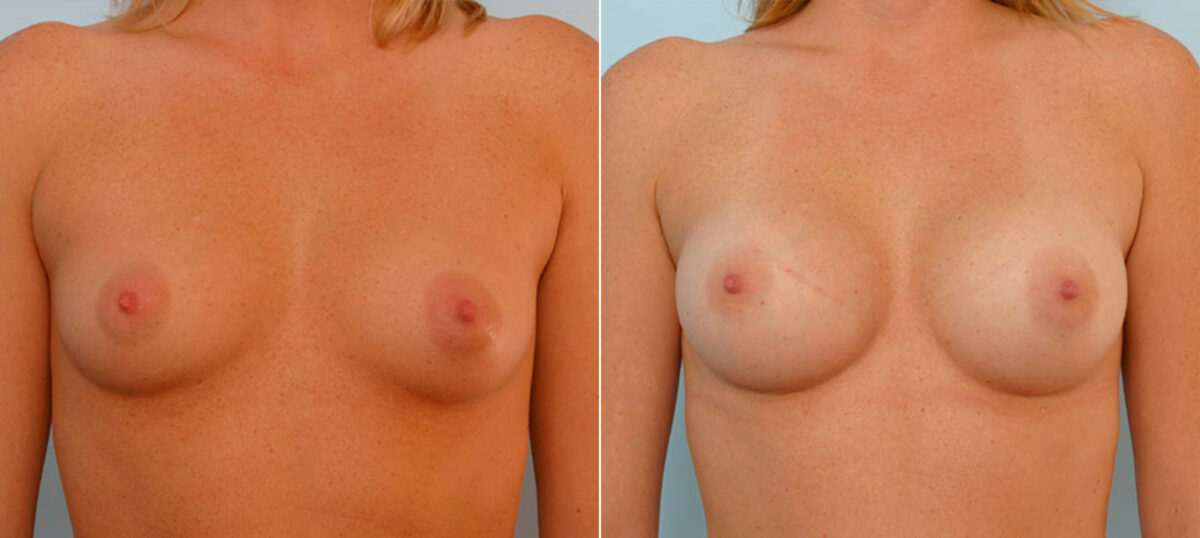 Breast Augmentation before and after photos in Houston, TX, Patient 25544