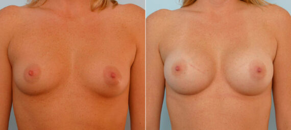 Breast Augmentation before and after photos in Houston, TX, Patient 25544