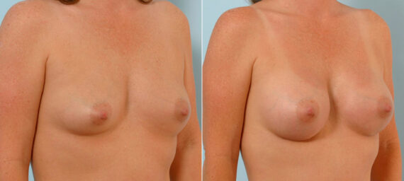 Breast Augmentation before and after photos in Houston, TX, Patient 25551