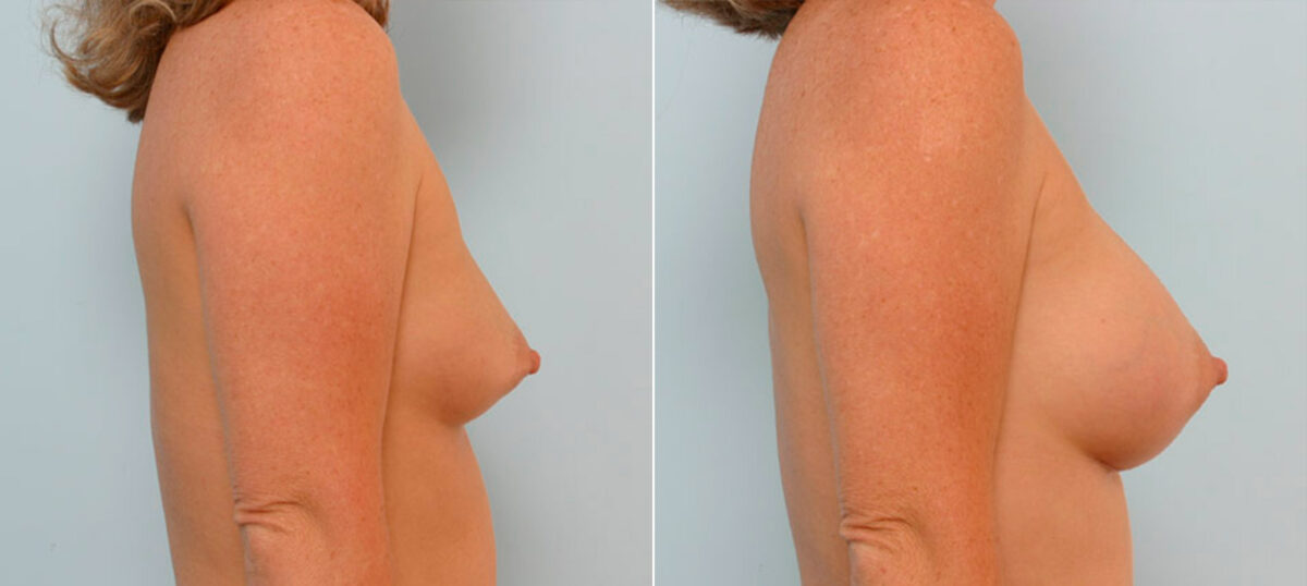 Breast Augmentation before and after photos in Houston, TX, Patient 25551