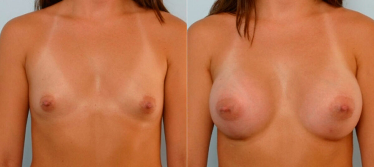 Patient 25558, Breast Augmentation before and after photos Breast Augmentation before and after photos in Houston, TX, Patient 25558