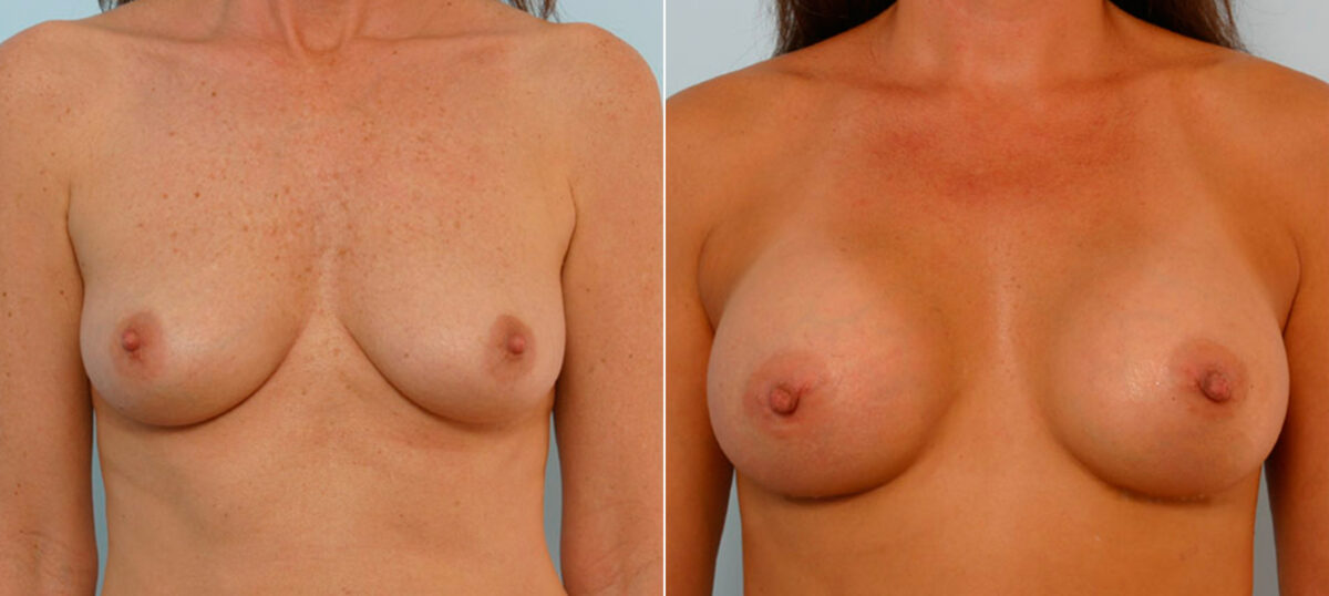 Breast Augmentation before and after photos in Houston, TX, Patient 25565