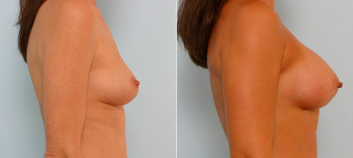 Breast Augmentation before and after photos in Houston, TX, Patient 25565