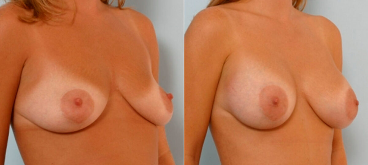 Breast Augmentation before and after photos in Houston, TX, Patient 25572