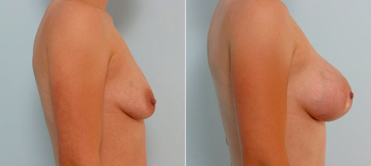 Breast Augmentation before and after photos in Houston, TX, Patient 25579
