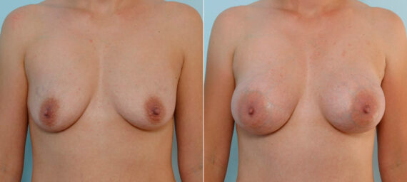 Breast Augmentation before and after photos in Houston, TX, Patient 25579