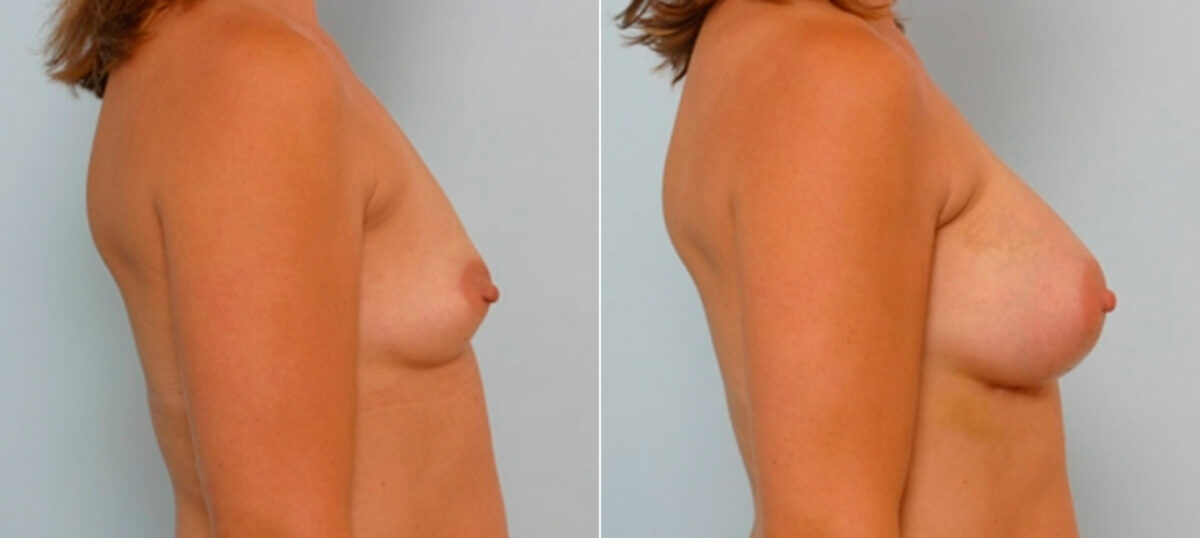Breast Augmentation before and after photos in Houston, TX, Patient 25586