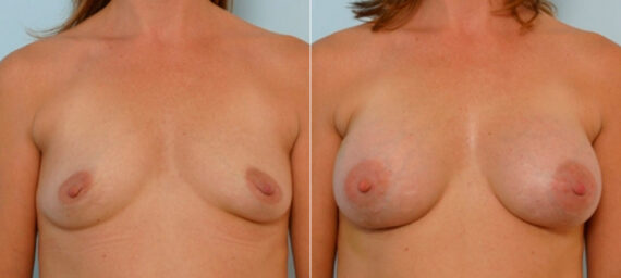 Breast Augmentation before and after photos in Houston, TX, Patient 25586