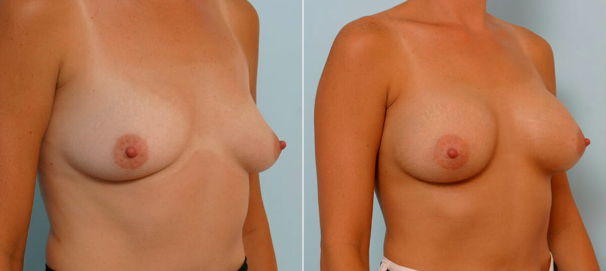 Breast Augmentation before and after photos in Houston, TX, Patient 25600