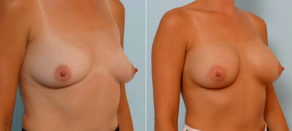 Breast Augmentation before and after photos in Houston, TX, Patient 25600