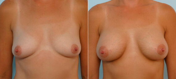 Breast Augmentation before and after photos in Houston, TX, Patient 25600