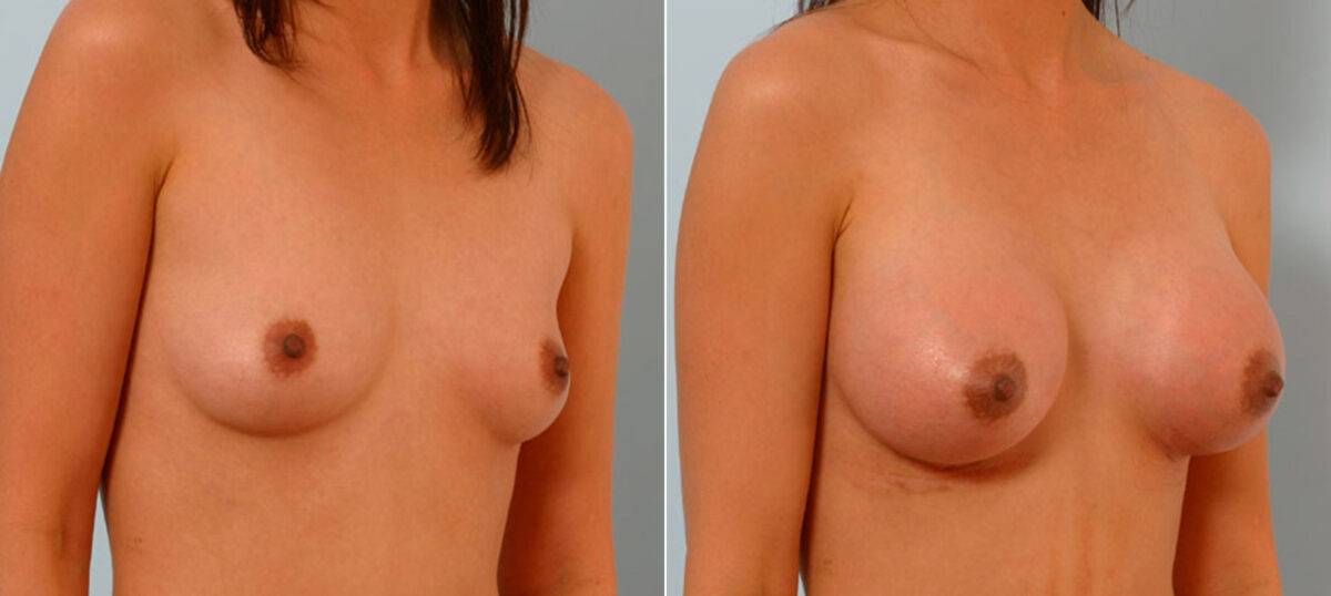 Breast Augmentation before and after photos in Houston, TX, Patient 25607