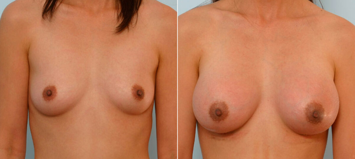 Patient 25607, Breast Augmentation before and after photos Breast Augmentation before and after photos in Houston, TX, Patient 25607