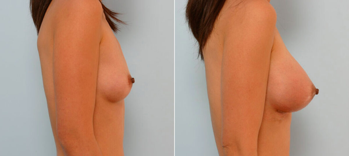 Breast Augmentation before and after photos in Houston, TX, Patient 25607