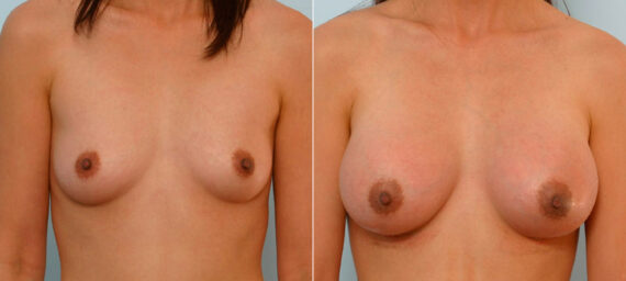 Breast Augmentation before and after photos in Houston, TX, Patient 25607