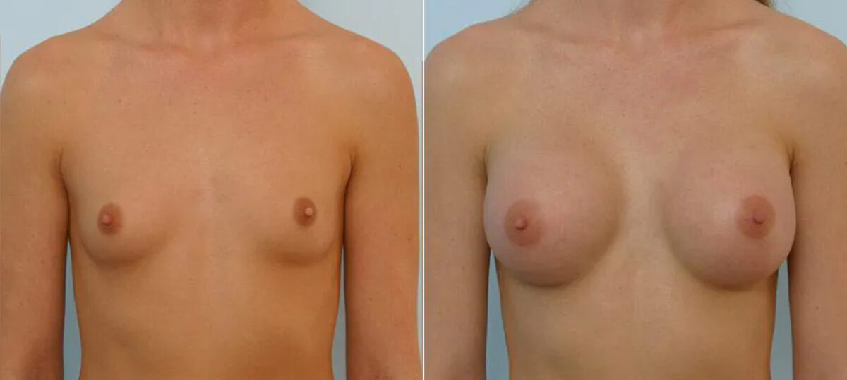 Patient 25614, Breast Augmentation before and after photos Breast Augmentation before and after photos in Houston, TX, Patient 25614