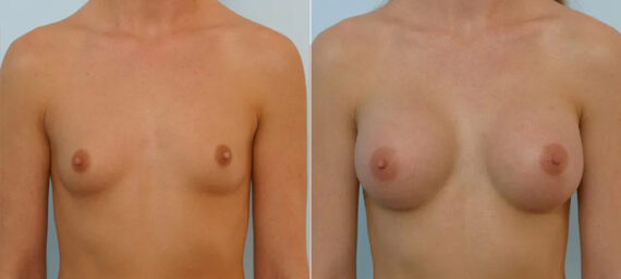 Breast Augmentation before and after photos in Houston, TX, Patient 25614