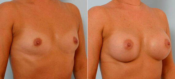 Breast Augmentation before and after photos in Houston, TX, Patient 25621