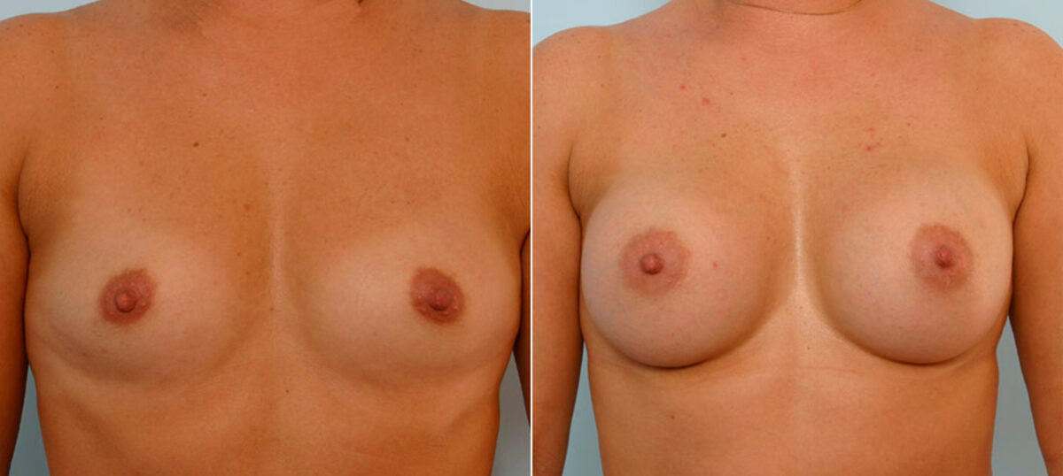 Patient 25621, Breast Augmentation before and after photos Breast Augmentation before and after photos in Houston, TX, Patient 25621