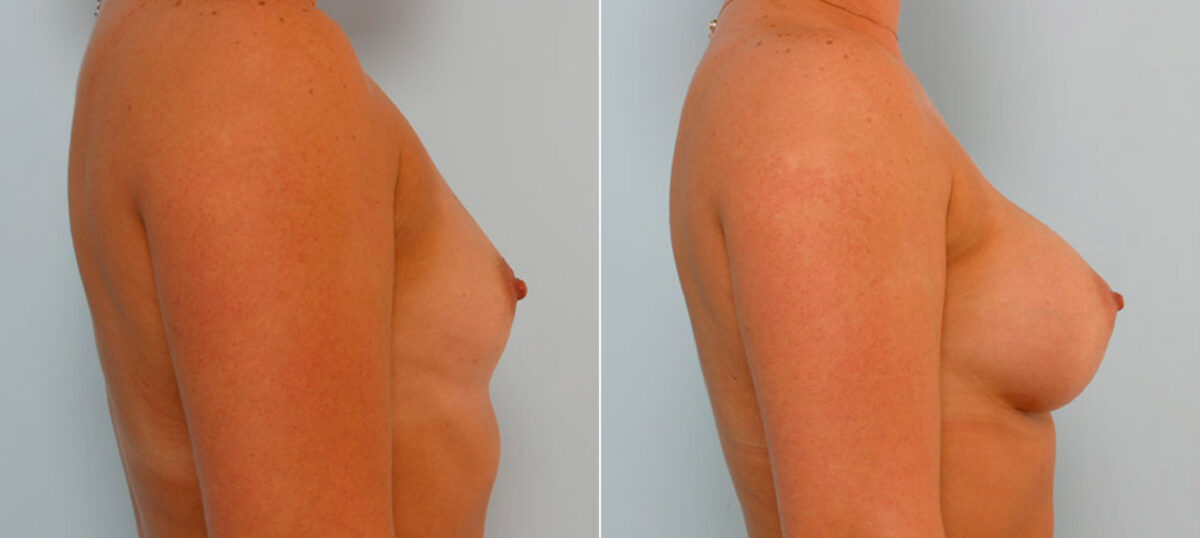 Breast Augmentation before and after photos in Houston, TX, Patient 25621