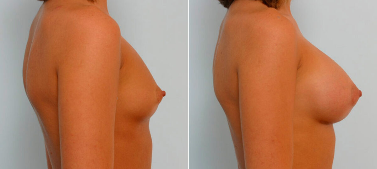 Breast Augmentation before and after photos in Houston, TX, Patient 25628
