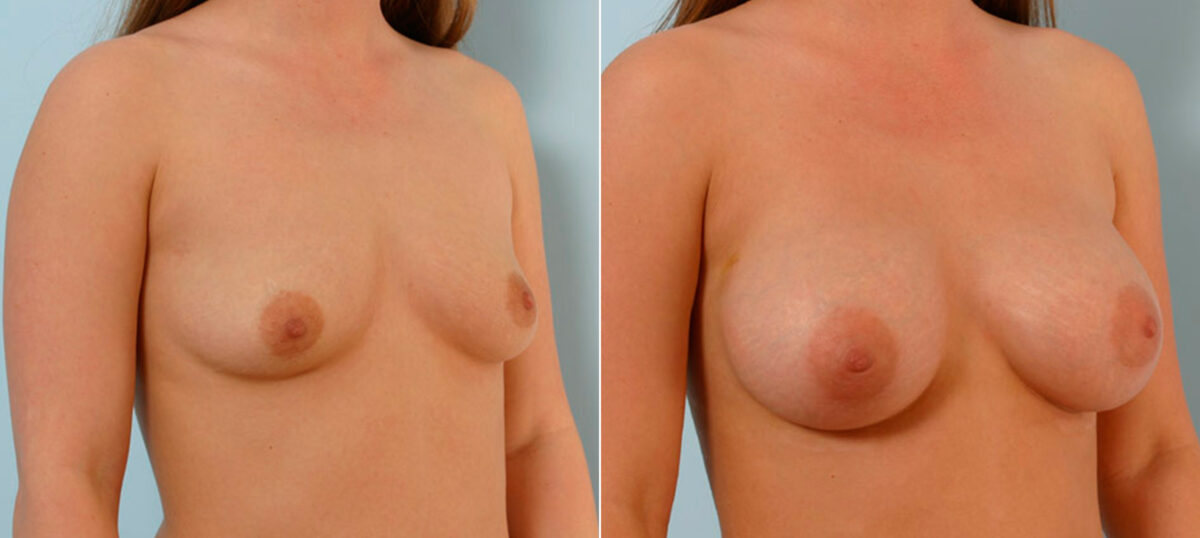 Breast Augmentation before and after photos in Houston, TX, Patient 25635