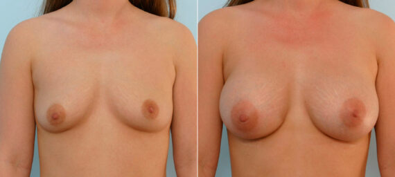 Breast Augmentation before and after photos in Houston, TX, Patient 25635