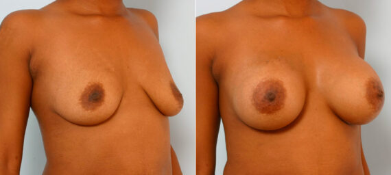Breast Augmentation before and after photos in Houston, TX, Patient 25642