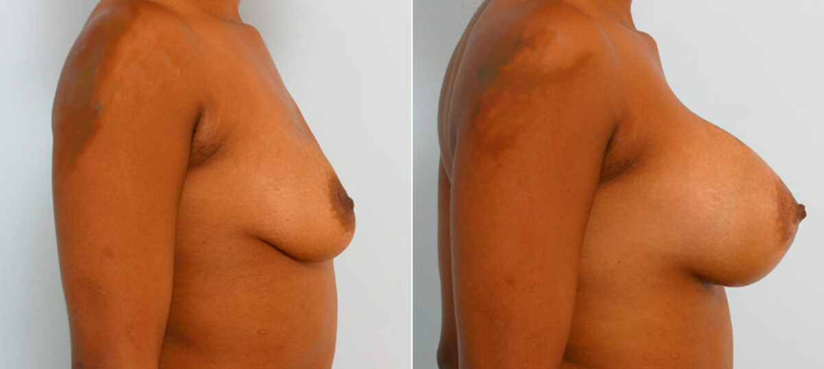 Breast Augmentation before and after photos in Houston, TX, Patient 25642