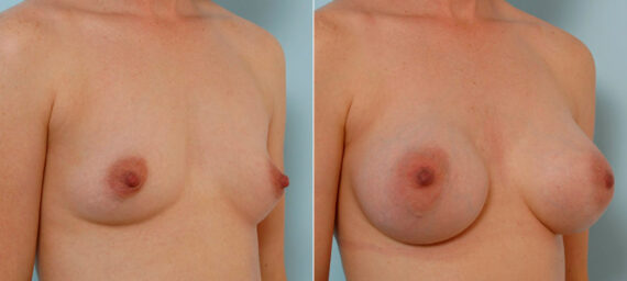 Breast Augmentation before and after photos in Houston, TX, Patient 25649