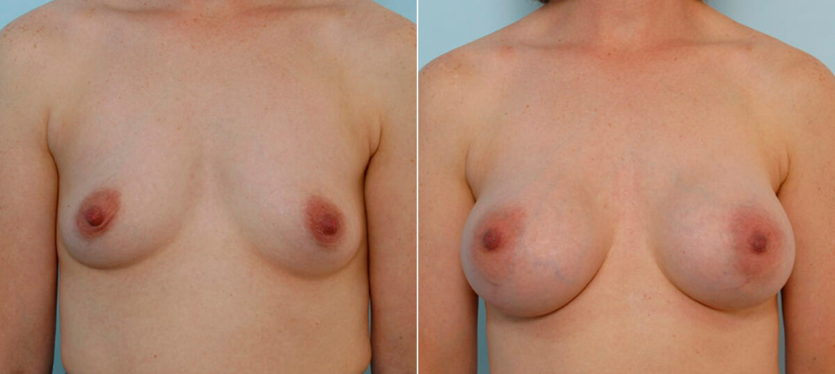 Patient 25649, Breast Augmentation before and after photos Breast Augmentation before and after photos in Houston, TX, Patient 25649