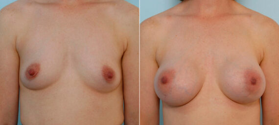 Breast Augmentation before and after photos in Houston, TX, Patient 25649
