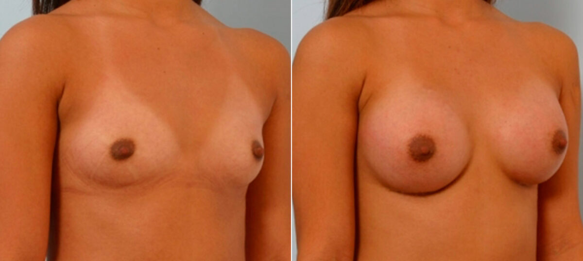 Breast Augmentation before and after photos in Houston, TX, Patient 25656