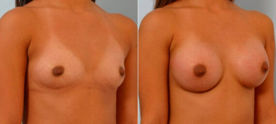 Breast Augmentation before and after photos in Houston, TX, Patient 25656