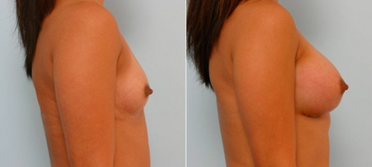 Breast Augmentation before and after photos in Houston, TX, Patient 25656
