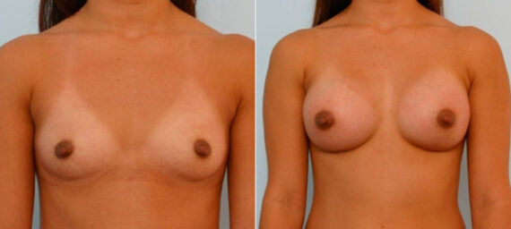 Breast Augmentation before and after photos in Houston, TX, Patient 25656