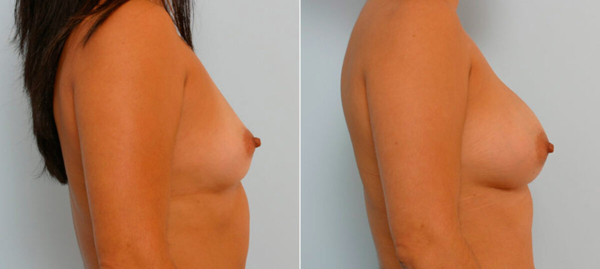 Breast Augmentation before and after photos in Houston, TX, Patient 25663