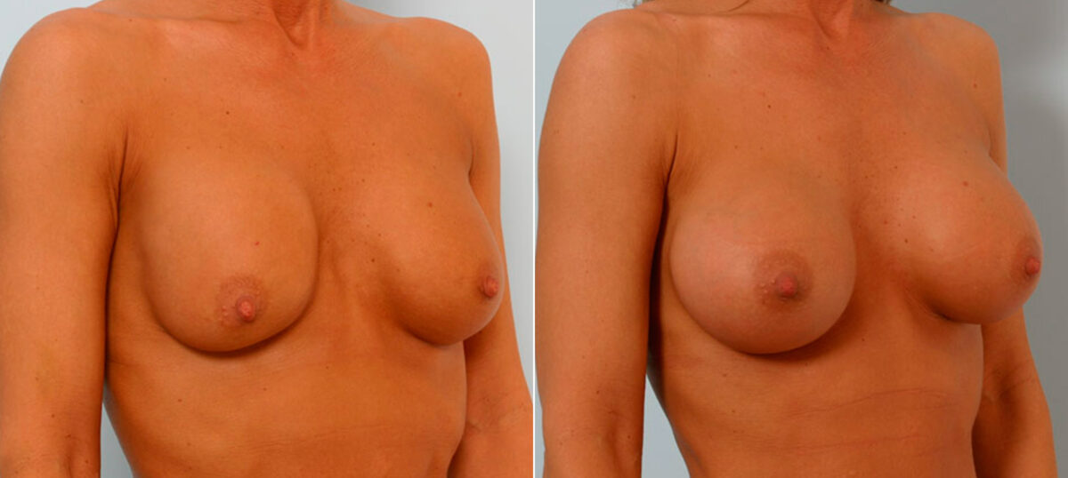 Breast Augmentation before and after photos in Houston, TX, Patient 25677