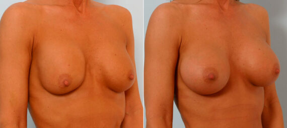 Breast Augmentation before and after photos in Houston, TX, Patient 25677