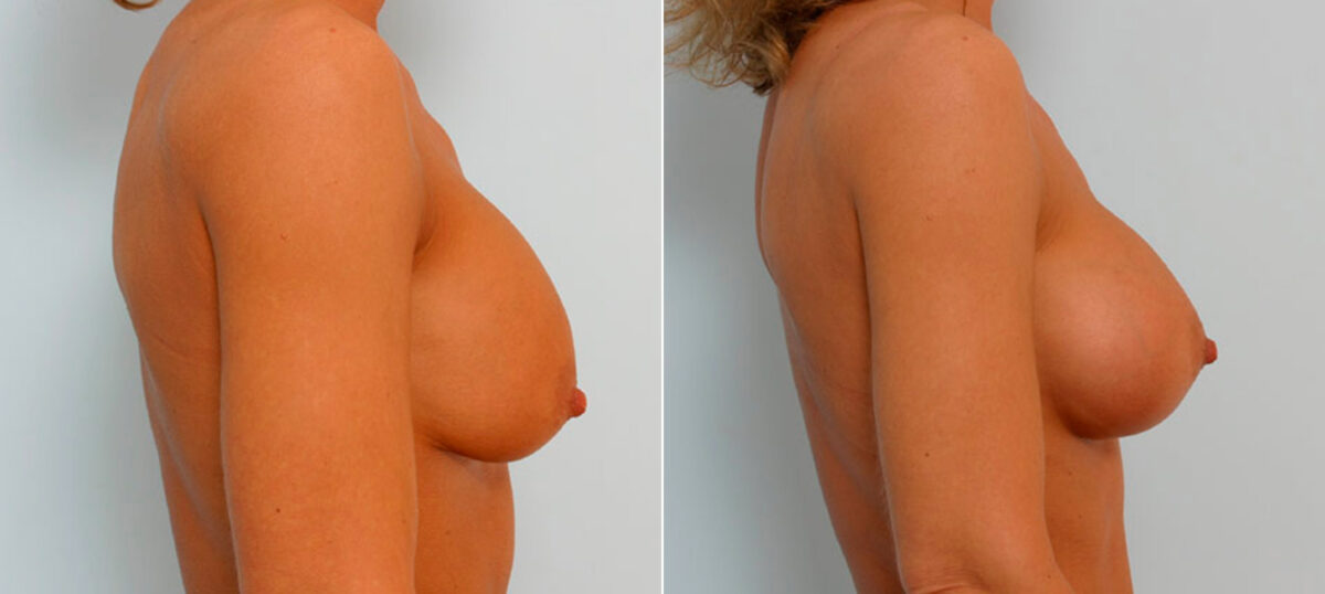 Breast Augmentation before and after photos in Houston, TX, Patient 25677