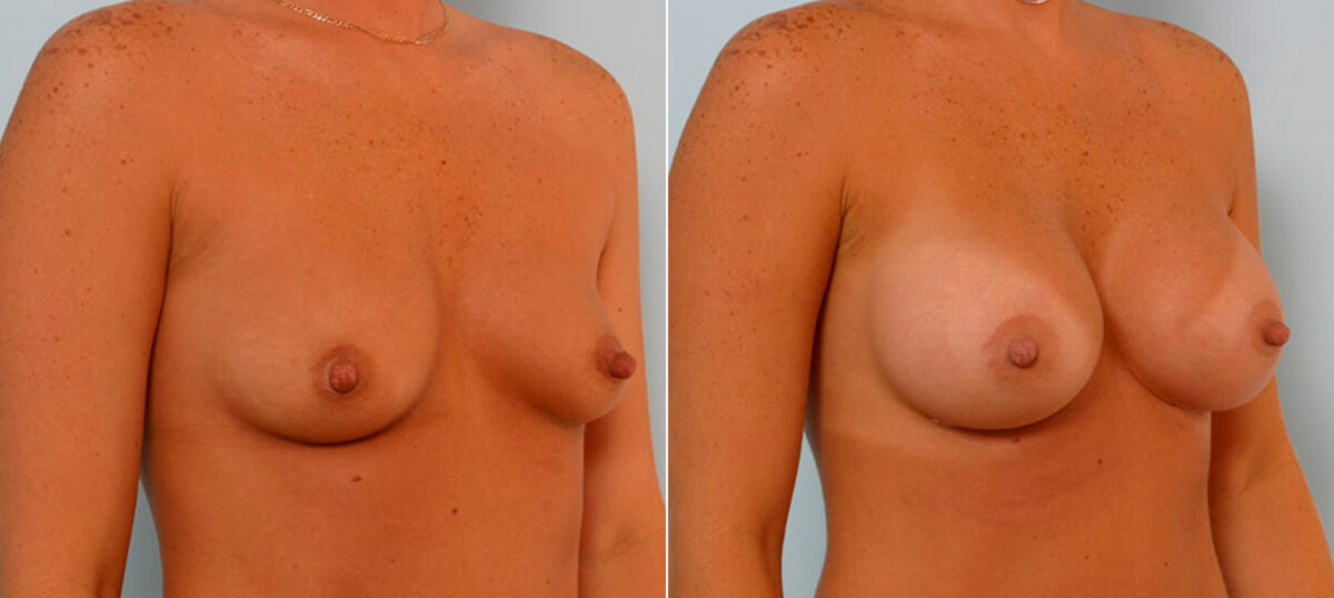 Breast Augmentation before and after photos in Houston, TX, Patient 25691