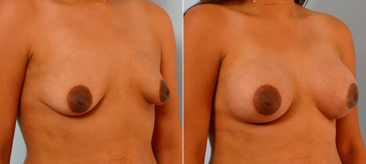 Breast Augmentation before and after photos in Houston, TX, Patient 25698